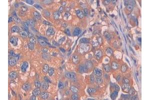 DAB staining on IHC-P; Samples: Human Breast cancer Tissue (Complement Factor B anticorps  (AA 35-160))