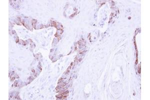 IHC-P Image Immunohistochemical analysis of paraffin-embedded CA922 xenograft , using LIM kinase 2, antibody at 1:500 dilution.