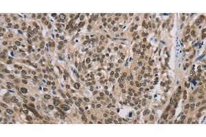 Immunohistochemistry of paraffin-embedded Human esophagus cancer using IRF9 Polyclonal Antibody at dilution of 1:50 (IRF9 anticorps)