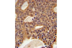 DCLRE1B Antibody immunohistochemistry analysis in formalin fixed and paraffin embedded human prostate carcinoma followed by peroxidase conjugation of the secondary antibody and DAB staining. (DCLRE1B anticorps  (AA 208-236))