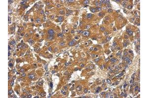 IHC-P Image Immunohistochemical analysis of paraffin-embedded human hepatoma, using Factor B, antibody at 1:500 dilution. (Complement Factor B anticorps)