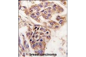 Formalin-fixed and paraffin-embedded human breast carcinoma tissue reacted with C8orf32 antibody (Center), which was peroxidase-conjugated to the secondary antibody, followed by DAB staining. (WDYHV1 anticorps  (AA 106-136))