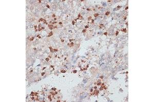 Immunohistochemistry of paraffin-embedded human uterine cancer using Cathepsin G antibody (ABIN6127686, ABIN6139228, ABIN6139230 and ABIN6217069) at dilution of 1:100 (40x lens).