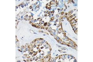 Immunohistochemistry of paraffin-embedded human thyroid cancer using PRC1 Rabbit pAb (ABIN6128502, ABIN6146124, ABIN6146125 and ABIN6222808) at dilution of 1:100 (40x lens). (PRC1 anticorps  (AA 351-620))