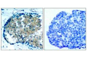 Immunohistochemical analysis of paraffin-embedded human breast carcinoma tissue using Ezrin(Phospho-Tyr353) Antibody(left) or the same antibody preincubated with blocking peptide(right).