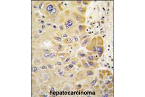 Formalin-fixed and paraffin-embedded human hepatocarcinoma tissue reacted with ALDH2 antibody , which was peroxidase-conjugated to the secondary antibody, followed by DAB staining.