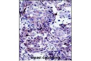 CTTN Antibody (Center) (ABIN657649 and ABIN2846644) immunohistochemistry analysis in formalin fixed and paraffin embedded human breast carcinoma followed by peroxidase conjugation of the secondary antibody and DAB staining. (Cortactin anticorps  (AA 273-302))