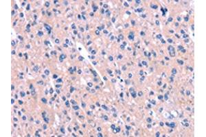 The image on the left is immunohistochemistry of paraffin-embedded Human liver cancer tissue using ABIN7190562(ENPP4 Antibody) at dilution 1/15, on the right is treated with synthetic peptide. (ENPP4 anticorps)
