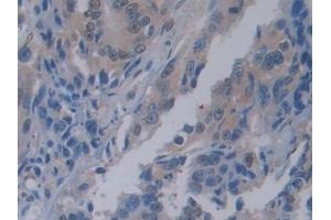 Detection of PTF1a in Human Colorectal cancer Tissue using Polyclonal Antibody to Pancreas Specific Transcription Factor 1a (PTF1a)