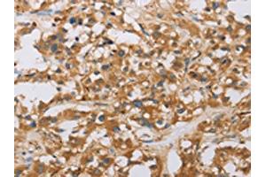 The image on the left is immunohistochemistry of paraffin-embedded Human thyroid cancer tissue using ABIN7130805(RAD54L2 Antibody) at dilution 1/40, on the right is treated with fusion protein. (ARIP4 anticorps)