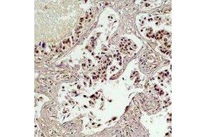 Immunohistochemical analysis of CREB staining in human lung cancer formalin fixed paraffin embedded tissue section. (CREB1 anticorps)