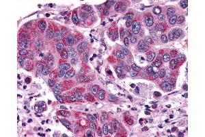 Anti-ACKR3 / CXCR7 / RDC1 antibody IHC of human Colon, Carcinoma. (CXCR7 anticorps  (Cytoplasmic Domain))