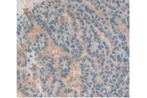 Detection of TIGIT in Human Thyroid Cancer Tissue using Polyclonal Antibody to T-Cell Immunoreceptor With Ig And ITIM Domains Protein (TIGIT)