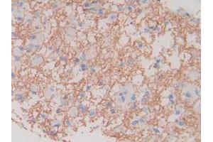 IHC-P analysis of Human Glioma Tissue, with DAB staining. (MBP anticorps  (AA 135-190))