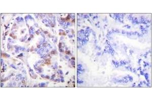 Immunohistochemistry analysis of paraffin-embedded human lung carcinoma, using RFA2 (Phospho-Thr21) Antibody. (RPA2 anticorps  (pThr21))