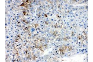 IHC testing of FFPE human liver cancer tissue with AKR1B10 antibody at 1ug/ml.