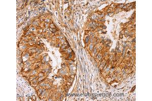 Immunohistochemistry of Human cervical cancer using CD59 Polyclonal Antibody at dilution of 1:50 (CD59 anticorps)