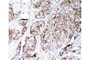 IHC-P: VE-Cadherin antibody testing of human lung cancer tissue (Cadherin 5 anticorps  (AA 766-784))