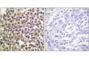 Immunohistochemistry analysis of paraffin-embedded human breast carcinoma, using p130 Cas (Phospho-Tyr249) Antibody. (BCAR1 anticorps  (pTyr249))