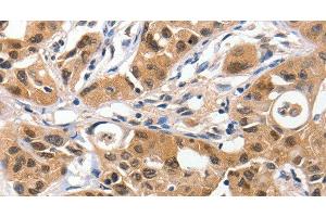 Immunohistochemistry of paraffin-embedded Human lung cancer using 14-3-3 epsilon Polyclonal Antibody at dilution of 1:100 (YWHAE anticorps)