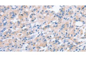 Immunohistochemistry of paraffin-embedded Human thyroid cancer using NCAPD2 Polyclonal Antibody at dilution of 1:40