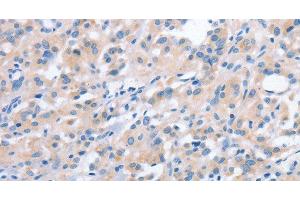 Immunohistochemistry of paraffin-embedded Human thyroid cancer using NCAPD2 Polyclonal Antibody at dilution of 1:40 (NCAPD2 anticorps)
