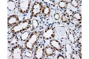 Immunohistochemical staining of paraffin-embedded Adenocarcinoma of ovary tissue using anti-CISD1mouse monoclonal antibody.
