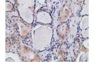 Immunohistochemical staining of paraffin-embedded Carcinoma of Human thyroid tissue using anti-RBBP9 mouse monoclonal antibody. (RBBP9 anticorps)