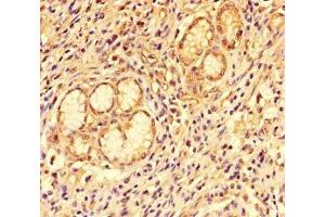 Immunohistochemistry of paraffin-embedded human gastric cancer using ABIN7146019 at dilution of 1:100