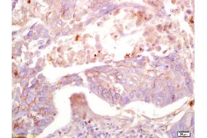 Formalin-fixed and paraffin embedded human lung carcinoma labeled with Anti-MAS1L Polyclonal Antibody, Unconjugated (ABIN759926) at 1:200 followed by conjugation to the secondary antibody and DAB staining. (MAS1L anticorps  (AA 201-300))