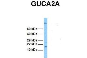 Host:  Rabbit  Target Name:  GUCA2A  Sample Tissue:  Human Stomach Tumor  Antibody Dilution:  1. (GUCA2A anticorps  (Middle Region))