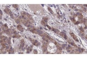 ABIN6273873 at 1/100 staining Human liver cancer tissue by IHC-P.