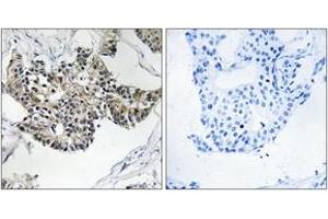 Immunohistochemistry analysis of paraffin-embedded human breast carcinoma tissue, using RSAD1 Antibody. (RSAD1 anticorps  (AA 298-347))