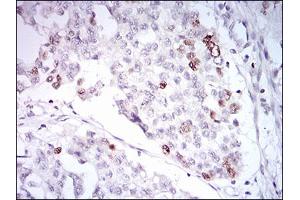 Immunohistochemical analysis of paraffin-embedded ovarian cancer tissues using TERF2 mouse mAb with DAB staining. (TRF2 anticorps  (AA 324-500))