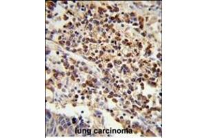 Formalin-fixed and paraffin-embedded human lung carcinoma reacted with U2AF1 Antibody (Center ) (ABIN389305 and ABIN2839425) , which was peroxidase-conjugated to the secondary antibody, followed by DAB staining. (U2AF1 anticorps  (AA 99-125))