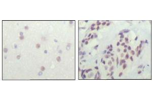 Immunohistochemical analysis of paraffin-embedded human cerebra (left) and breast carcinoma tissue (right), showing nuclear location with DAB staining using NCOR1 antibody. (NCOR1 anticorps  (AA 1-192))