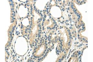 The image on the left is immunohistochemistry of paraffin-embedded Human thyroid cancer tissue using ABIN7193067(WNT6 Antibody) at dilution 1/35, on the right is treated with synthetic peptide. (WNT6 anticorps)