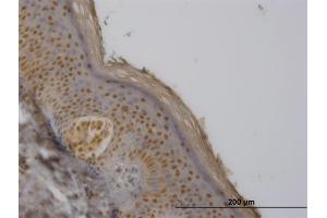 Immunoperoxidase of monoclonal antibody to FBXO11 on formalin-fixed paraffin-embedded human melanoma.