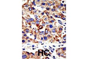Formalin-fixed and paraffin-embedded human hepatocellular carcinoma tissue reacted with the HDAC8 polyclonal antibody  , which was peroxidase-conjugated to the secondary antibody, followed by AEC staining. (HDAC8 anticorps  (N-Term))