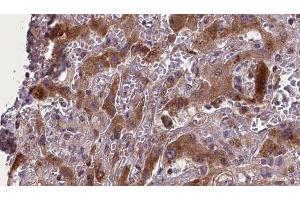 ABIN6277673 at 1/100 staining Human liver cancer tissue by IHC-P.