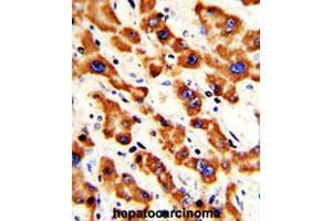 Formalin-fixed and paraffin-embedded human hepatocarcinomareacted with PHB polyclonal antibody , which was peroxidase-conjugated to the secondary antibody, followed by AEC staining. (Prohibitin anticorps  (AA 99-129))