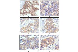 Immunohistochemical analysis of paraffin-embedded human breast intraductal carcinama tissues (A) and breast infiltrating ductal carcinama tissues (B) showing membrane localization using ERBB2 mouse mAb with DAB staining. (ErbB2/Her2 anticorps  (AA 750-987))
