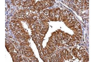 IHC-P Image MMP2 antibody detects MMP2 protein at cytosol on human endometrial carcinoma by immunohistochemical analysis.