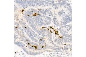 Immunohistochemistry of paraffin-embedded human colon carcinoma using Neutrophil Elastase (ELANE) Rabbit pAb (ABIN6131604, ABIN6140110, ABIN6140111 and ABIN6216843) at dilution of 1:25 (40x lens).
