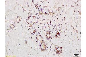 Formalin-fixed and paraffin embedded human breast carcinoma labeled with Anti RNF31/HOIP Polyclonal Antibody, Unconjugated (ABIN1387804) at 1:200 followed by conjugation to the secondary antibody and DAB staining. (RNF31 anticorps)