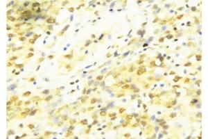 ABIN6273437 at 1/100 staining Human breast cancer tissue by IHC-P. (Cyclin T1 anticorps  (C-Term))