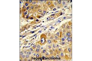 Formalin-fixed and paraffin-embedded human hepatocarcinoma reacted with MASTL Antibody, which was peroxidase-conjugated to the secondary antibody, followed by DAB staining.