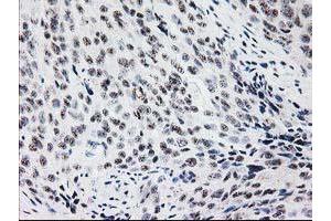 Immunohistochemical staining of paraffin-embedded Adenocarcinoma of Human breast tissue using anti-MGLL mouse monoclonal antibody. (MGLL anticorps)