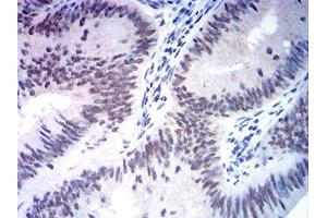 Immunohistochemical analysis of paraffin-embedded rectum cancer tissues using MSH2 mouse mAb with DAB staining.