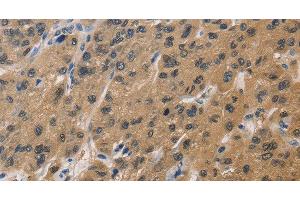 Immunohistochemistry of paraffin-embedded Human liver cancer tissue using DUSP26 Polyclonal Antibody at dilution 1:60 (DUSP26 anticorps)